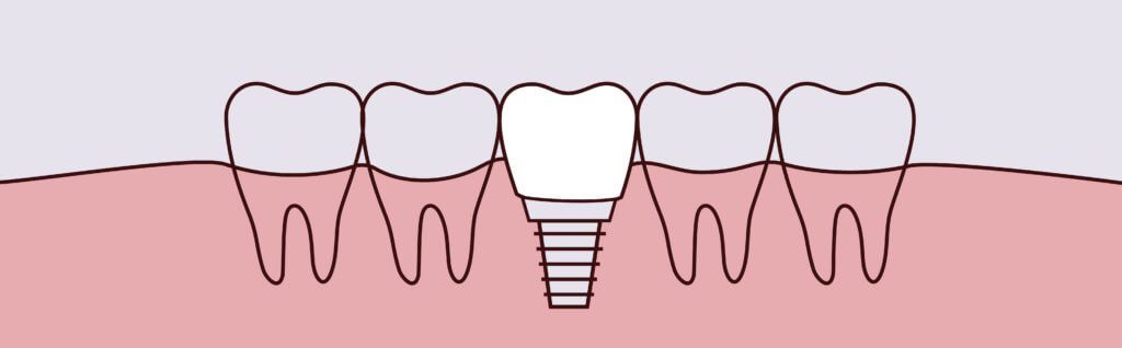 Dental Implants Dr. Mimi M. Cabanban Family Dentistry Dreamscape Imagery 05 Dr. Mimi M. Cabanban Family Dentistry