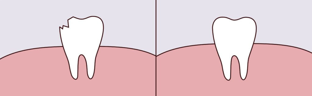 Dental Bonding Dr. Mimi M. Cabanban Family Dentistry Dreamscape Imagery 07 Dr. Mimi M. Cabanban Family Dentistry