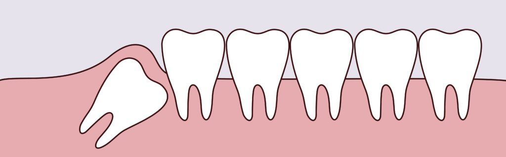 Wisdom Teeth Removal Dr. Mimi M. Cabanban Family Dentistry Dreamscape Imagery 08 Dr. Mimi M. Cabanban Family Dentistry