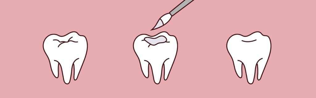 Dental Sealants Dr. Mimi M. Cabanban Family Dentistry Dreamscape Imagery 11 Dr. Mimi M. Cabanban Family Dentistry