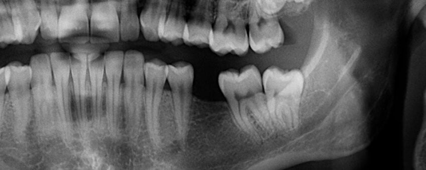 Tooth Extractions Dr. Mimi M. Cabanban Family Dentistry tooth Dr. Mimi M. Cabanban Family Dentistry