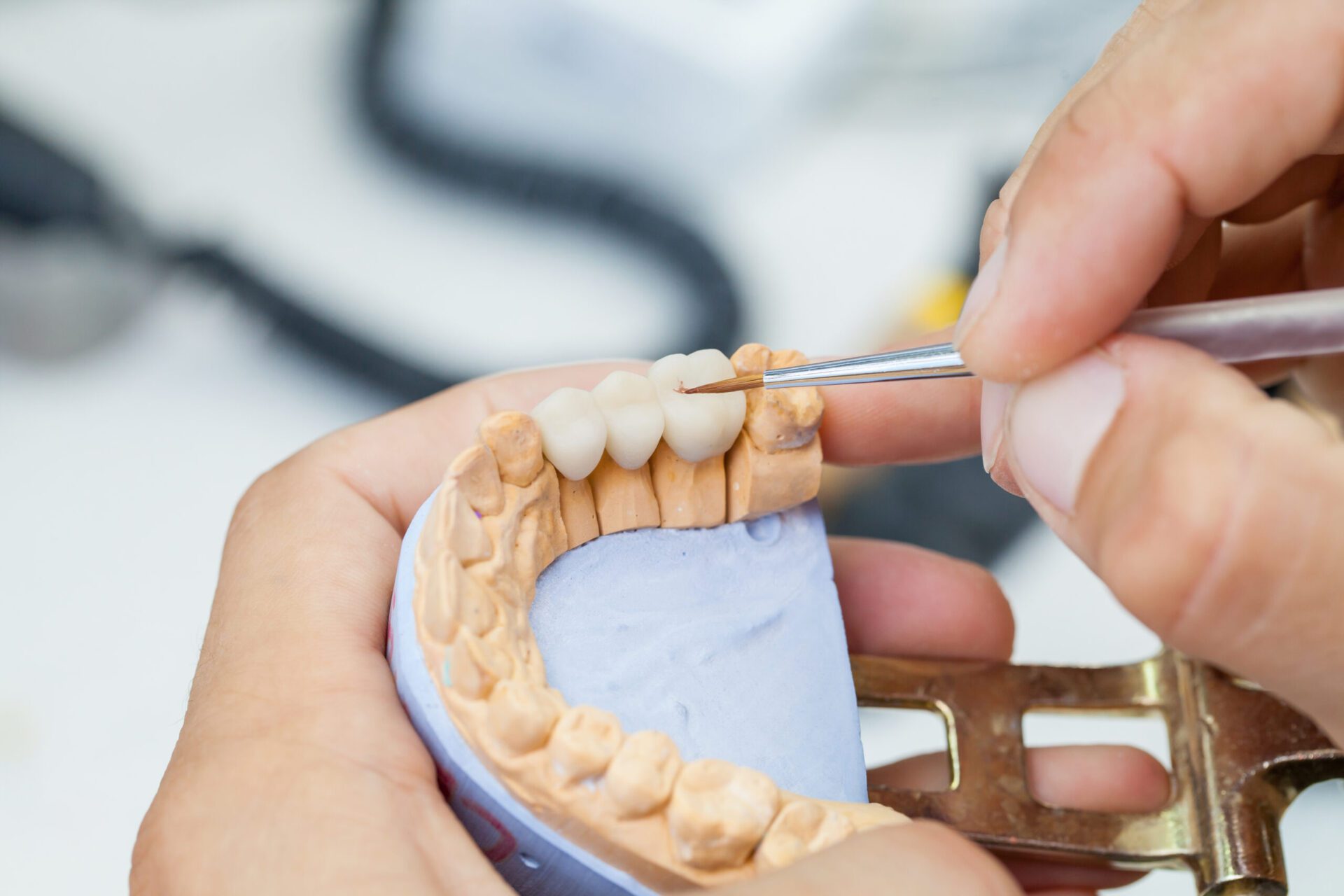 dental bridges in lakewood