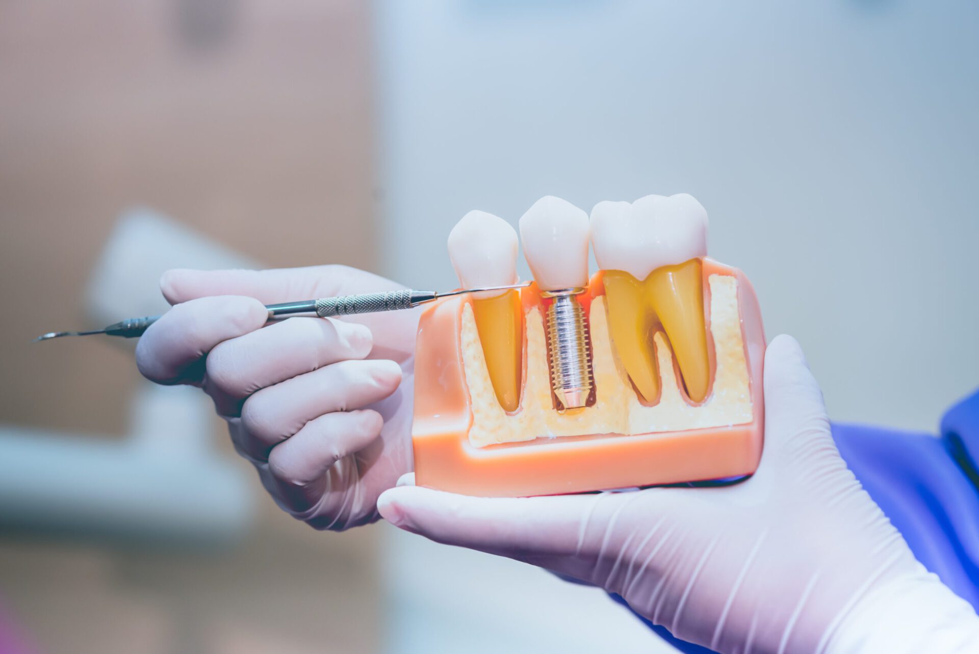 Dentist with tooth implant false teeth. Dentistry and healthcare dental implants in Lakewood